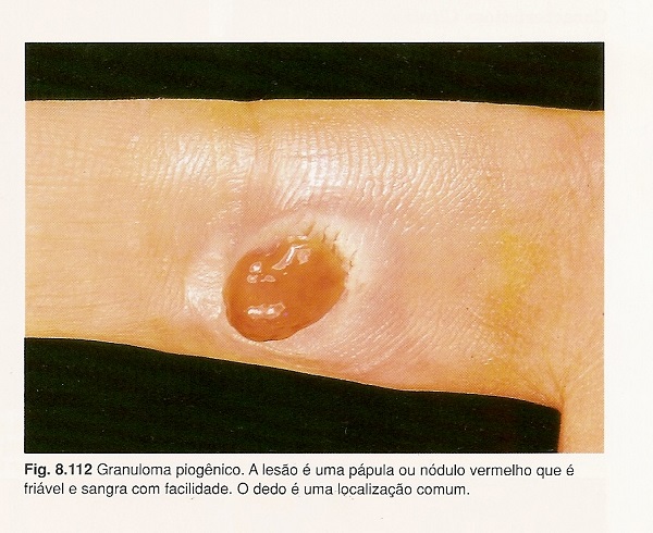  - fisiopatologia-dos-granulomas-foto191